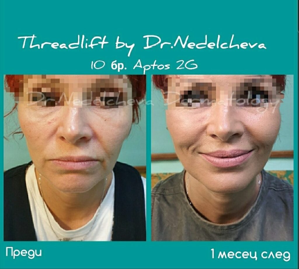 Fejslifting-konczi-DrNedelcheva26