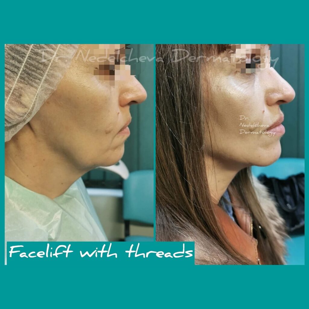 Fejslifting-konczi-DrNedelcheva27