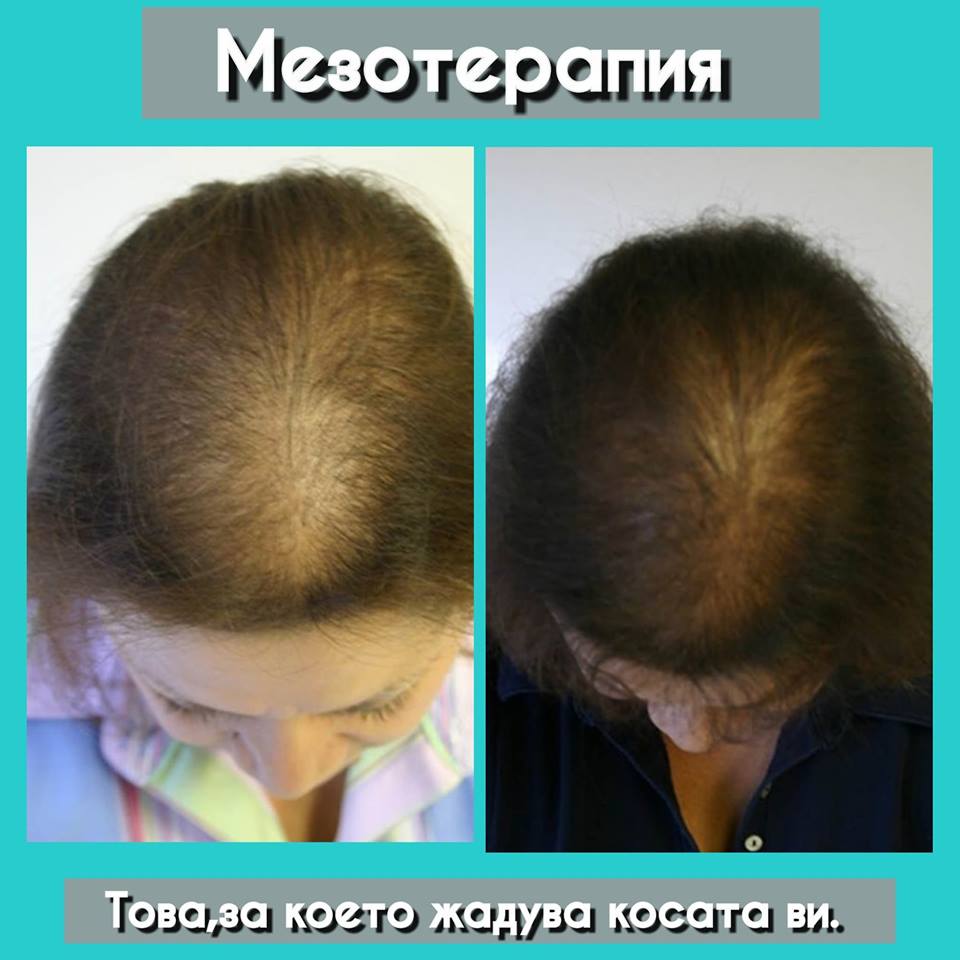 Mesotherapy