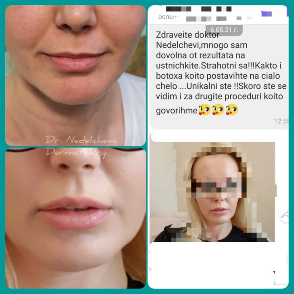 botoks-ustni-obratna-vrazka-dr-nedelchevi