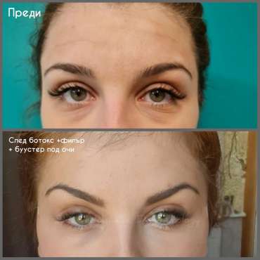 botoks36-370x370