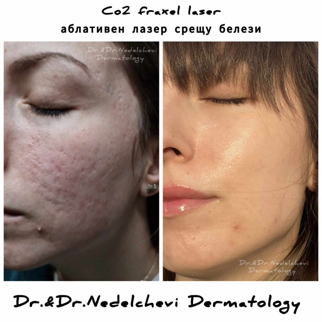 co2-fraxel-laser-dr-nedecheva