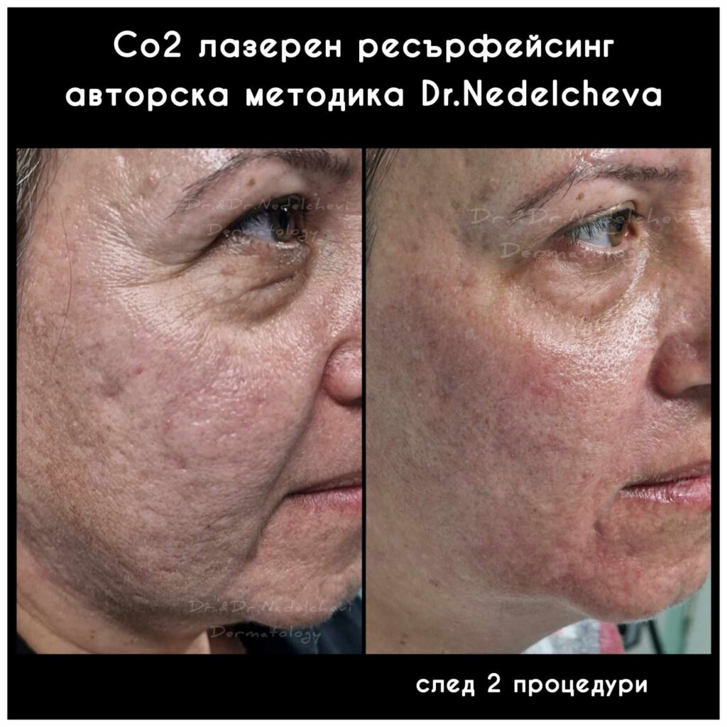 co2-laser-dr-nedelcheva