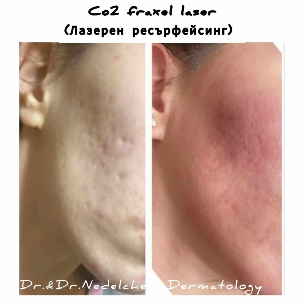 co2-laser-dr-nedelcheva-2322