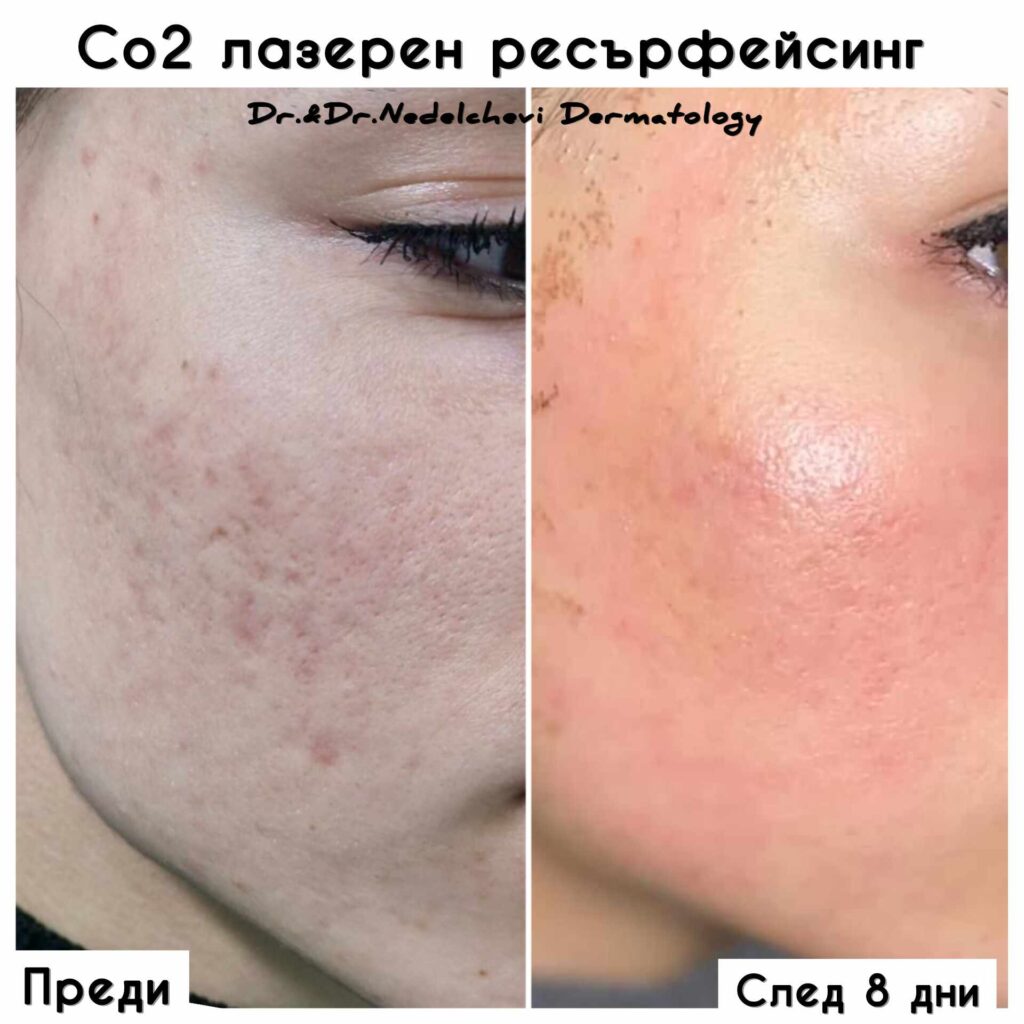 co2-laser-dr-nedelcheva-344