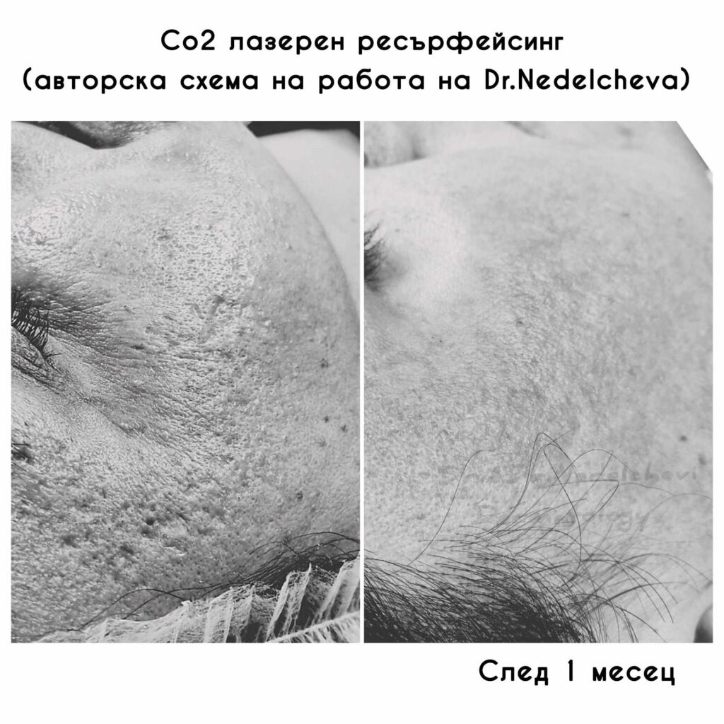 co2-laser-dr-nedelcheva-345