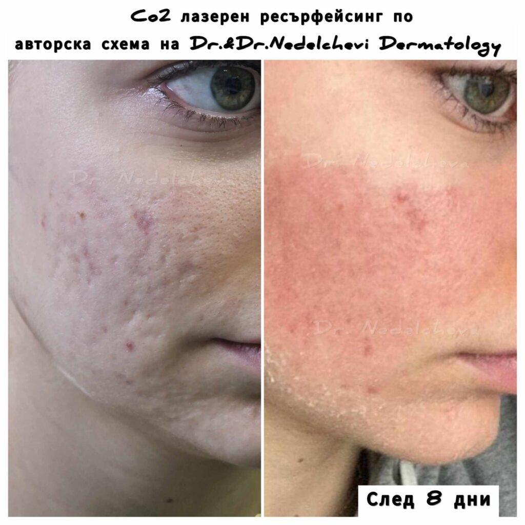 co2-laser-dr-nedelcheva-349