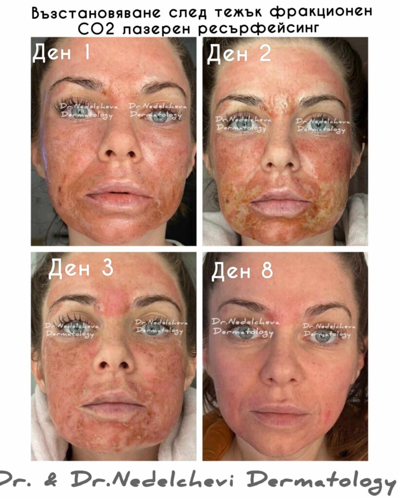 co2-laser-ressurfacing-dr-nedlechvea-etaps