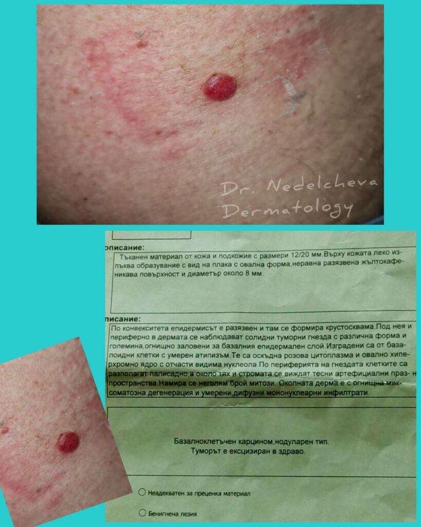 dermatohirurgiyabazotselularen