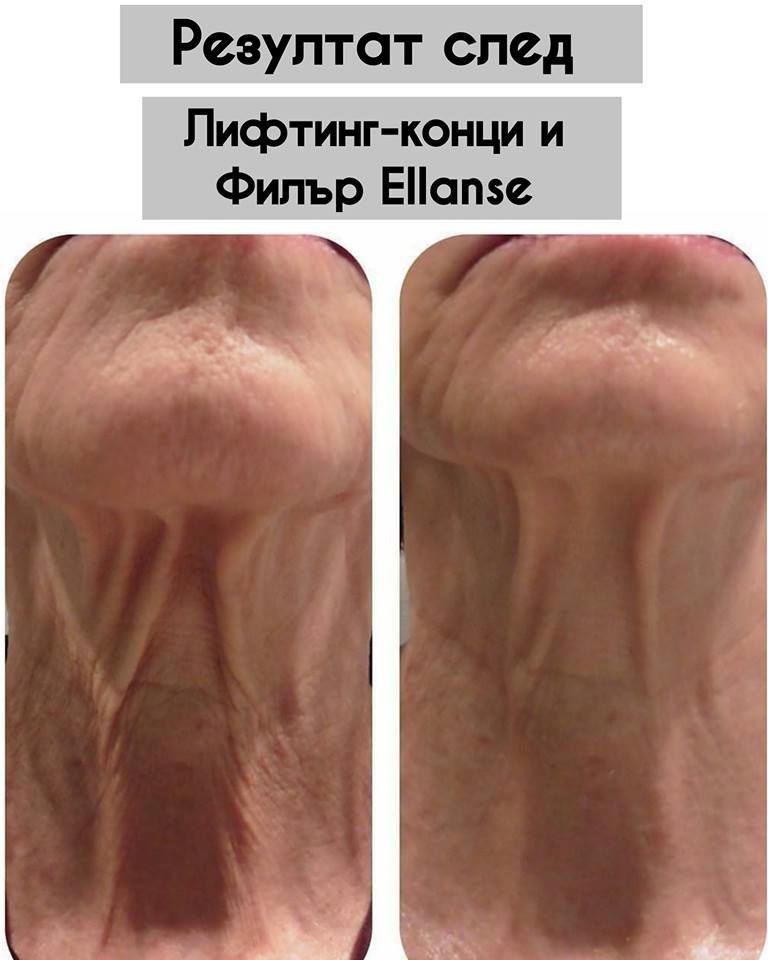 facelid