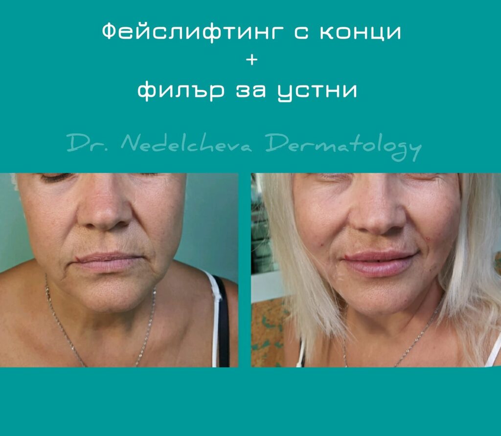 fejslifting-konczi-DrNedelcheva24