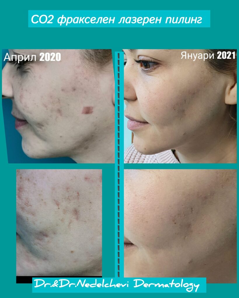 fraxel-laser-dr-nedelcheva