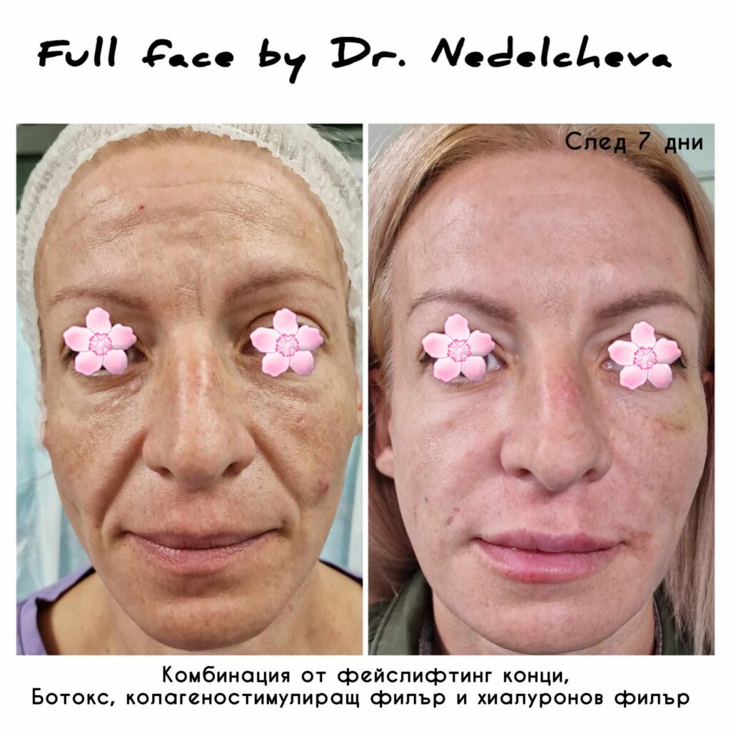 full-face-dr-nedelcehva-23672