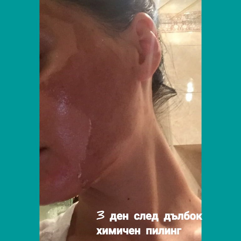 himichen-piling-drnedelcheva