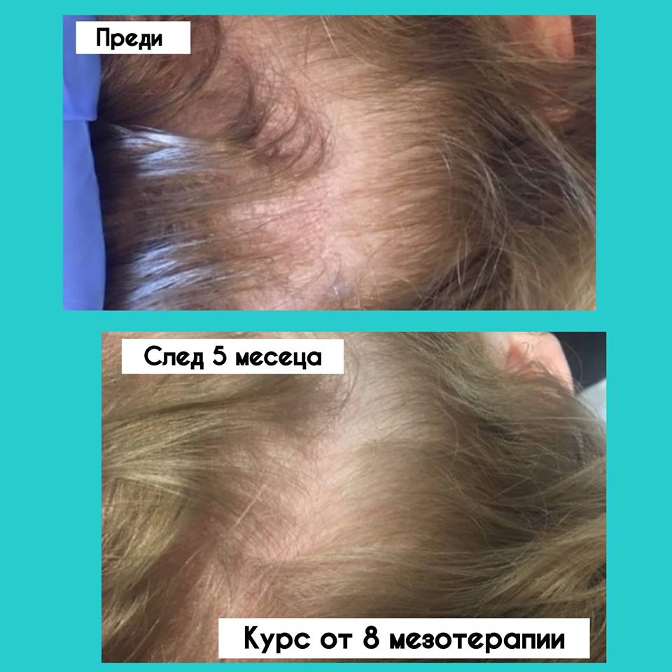 mesotherapy1