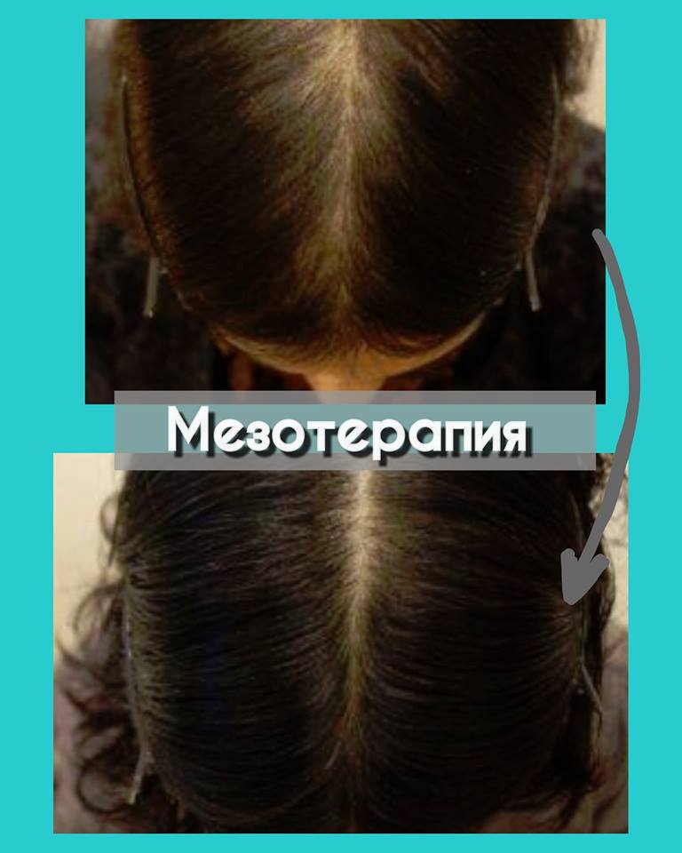 mesotherapy2