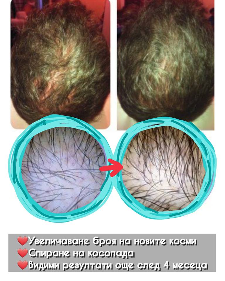 mesotherapy3