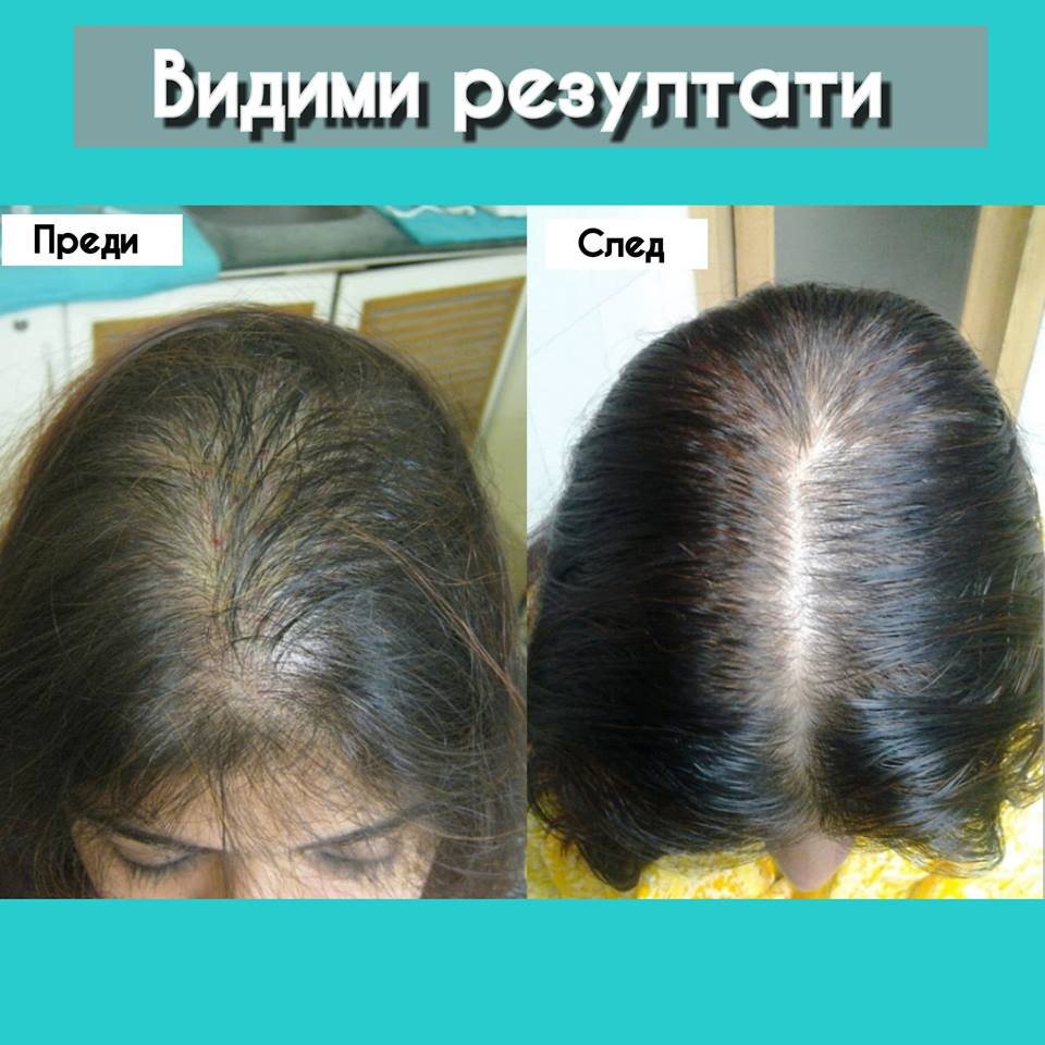 mesotherapy4