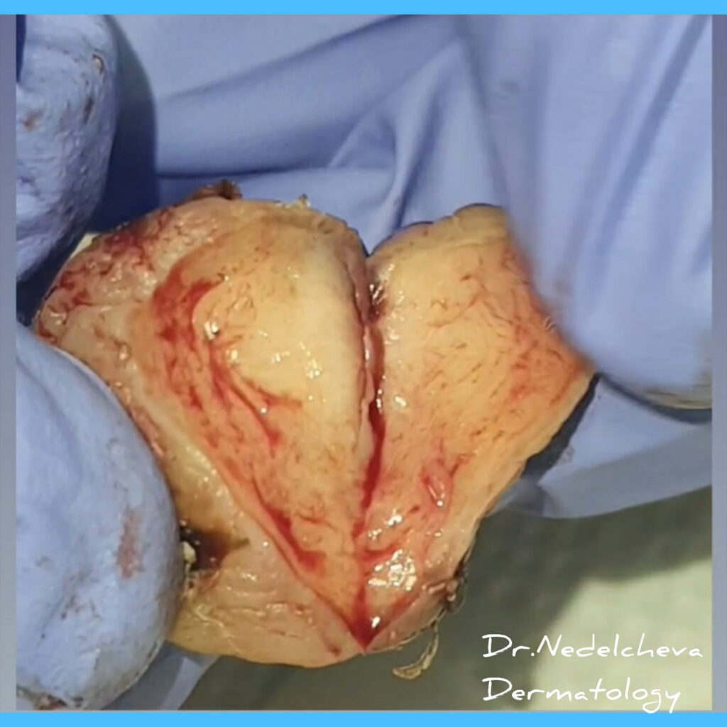 otstranen-fibrom