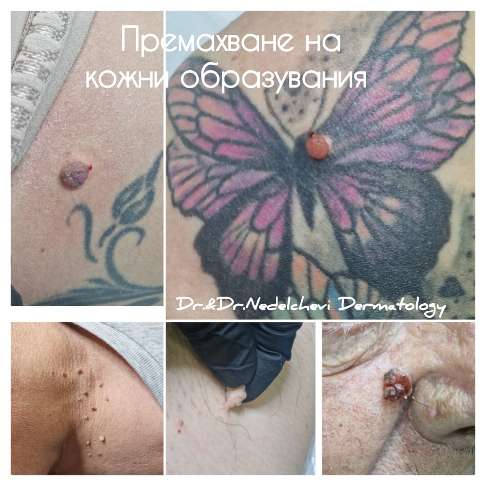 premahvane-na-tumori-drnedelchevi