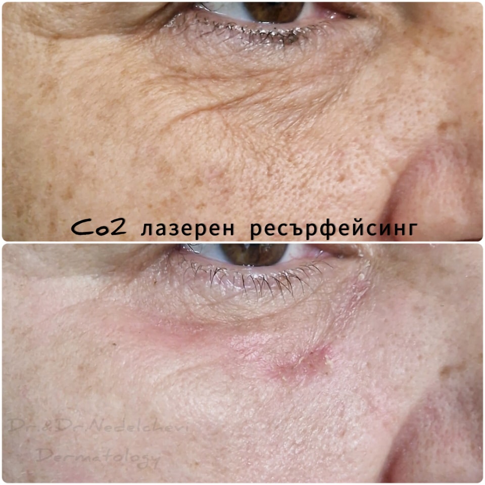 tso2-fraksel-resarfejsning